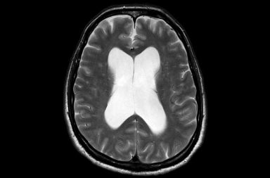 استسقاء الرأس سوي الضغط (NPH): الأسباب والأعراض والتشخيص والعلاج - حالة ناتجة عن تراكم غير طبيعي للسائل الدماغي الشوكي في تجاويف الدماغ