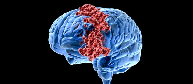 كيف قام دواء معروف قديمًا بالتّغلب على سرطان الدماغ؟