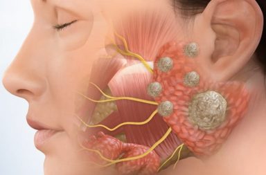 أورام الغدد اللعابية: الأسباب والأعراض والتشخيص والعلاج كيف تعالج الأورام التي تصيب الفم ما هي فرصة النجاة من سرطان الغدد اللعابية