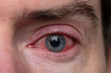يُعتقد أن مرض جفاف العين يعني ببساطة أن العين لا تنتج ما يكفي من الدموع. ولكن في الواقع توجد عدة أنواع من أمراض جفاف العين