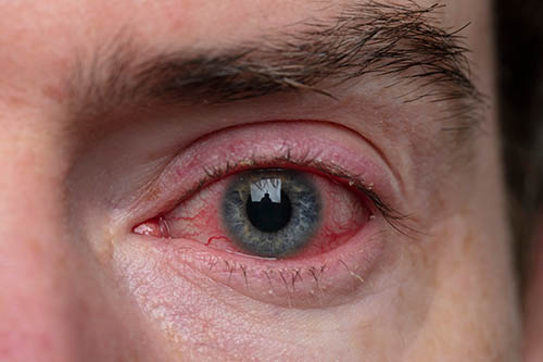 جفاف العين: الأسباب والأعراض والتشخيص والعلاج
