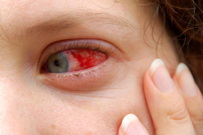 التهاب عنبية العين: الأسباب والأعراض والتشخيص والعلاج