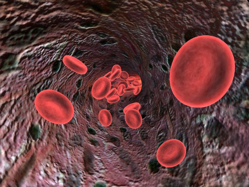 كثرة كريات الدم الحمراء: الأسباب والعلاج - حالة يصنع فيها الجسم كميات كبيرة من كريات الدم الحمراء - خلايا نقي العظم - مستويات الإريثروبويتين