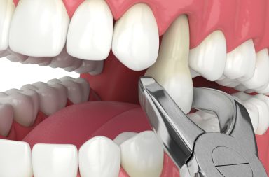 قلع الأسنان هو إجراء يهدف إلى إزالة سن واحدة أو عدد من الأسنان من تجويف الفم. ما الفرق بين القلع البسيط والقلع الجراحي؟ متى يعد قلع السن جراحيًا؟