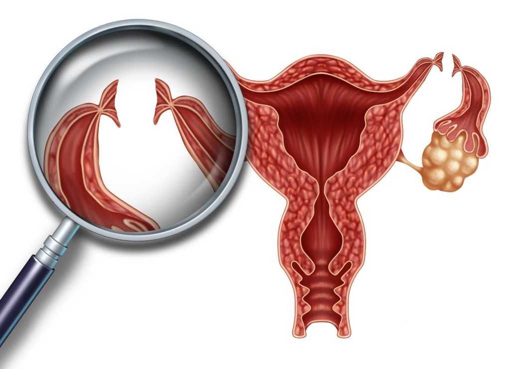 هل حدوث الحمل ممكن بعد عملية ربط البوقين؟ أم أنها وسيلة منع حمل فعالة