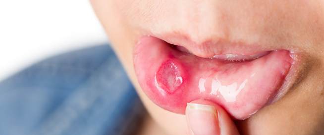 قرحات الفم أو القرحات القلاعية: أسبابها، وسبل علاجها