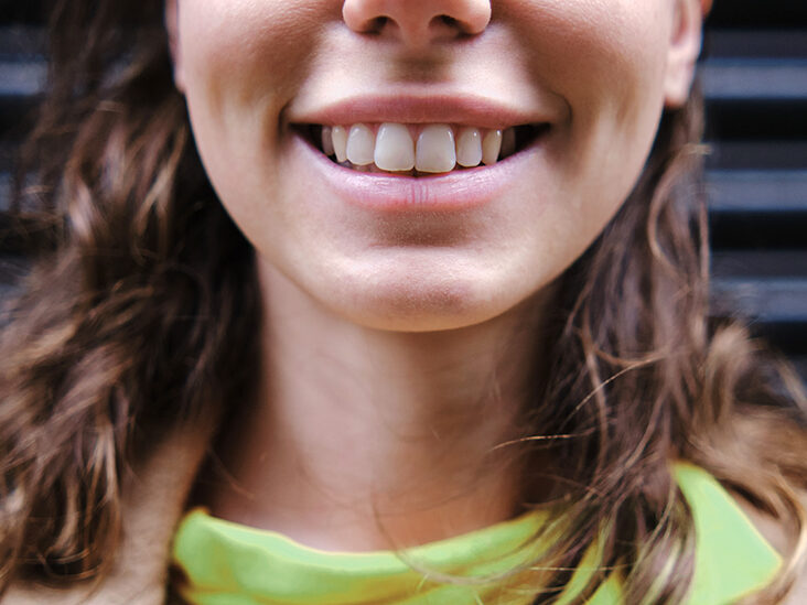 الميكروبات التي تسبب تسوس الأسنان قد تكون كائنات حية خارقة تسيطر على الأسنان
