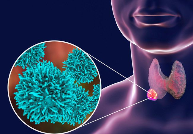 سرطان الدرق أو سرطان الغدة الدرقية - كل ما يجب أن تعرفه