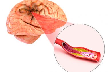 السكتة الدماغية الإقفارية: الأسباب والأعراض والتشخيص والعلاج - نقص تروية الدماغ ونقص تروية المخ - عائق في الشريان الذي يضخ الدم إلى الدماغ