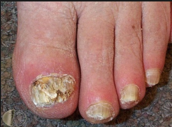 التهاب الظفر الفطري الفطار الظفري أو سعفة الأظفار tinea unguium - إنتان فطري جلدي يصيب الظفر - سعفة القدم - التهابات الأظفار الفطرية