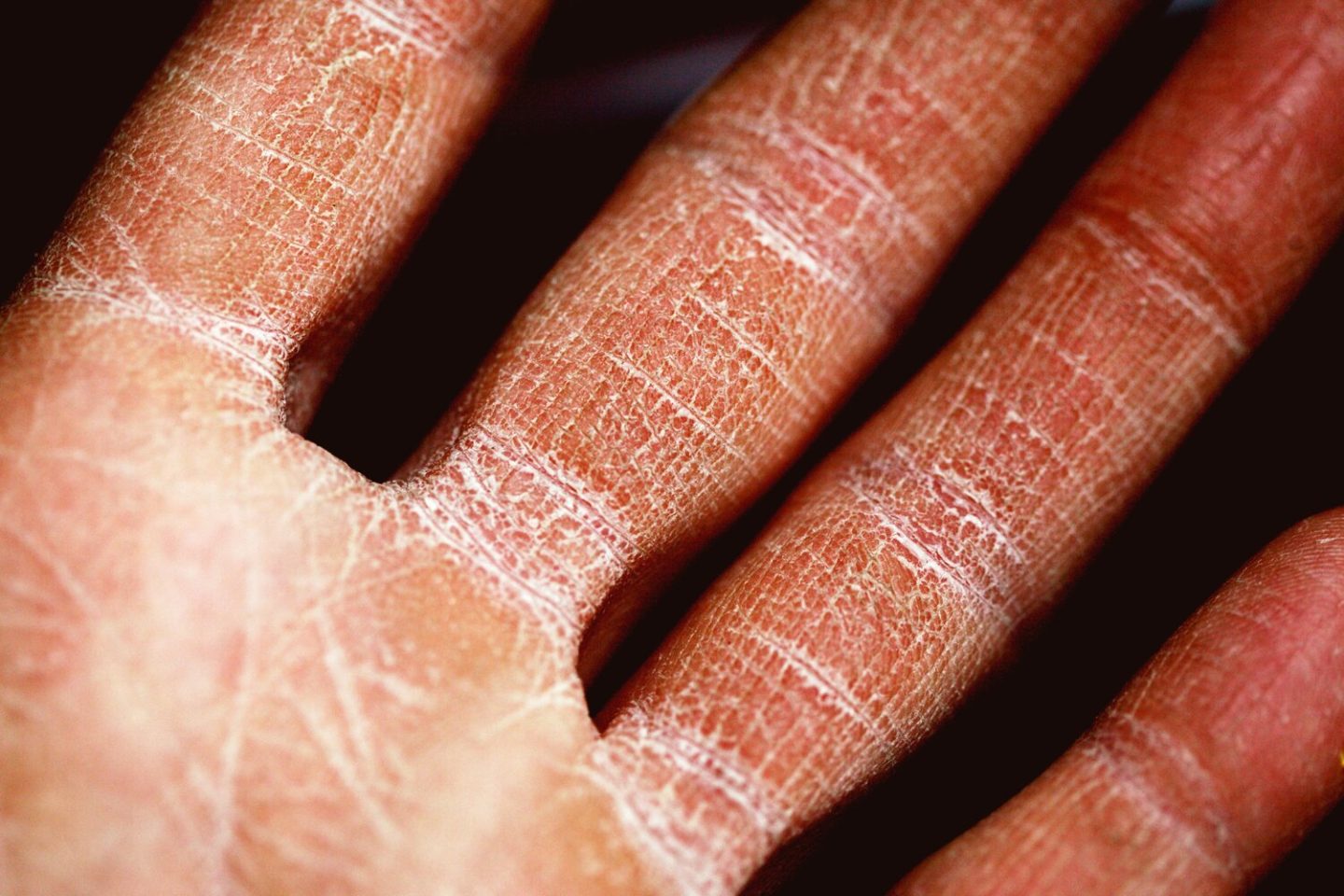 جفاف الجلد: الأسباب والأعراض والتشخيص والعلاج