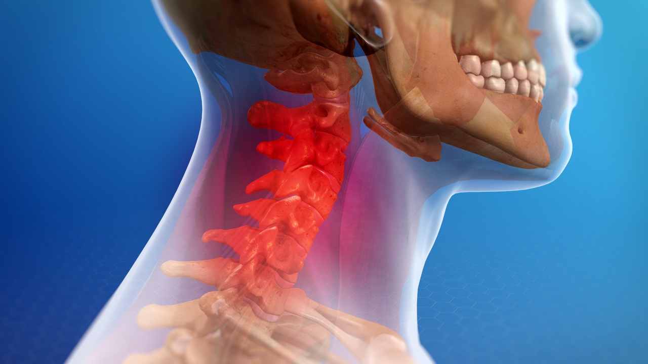 الإصابة المصعية (إصابة الرقبة المفاجئة): الأسباب والأعراض والتشخيص والعلاج