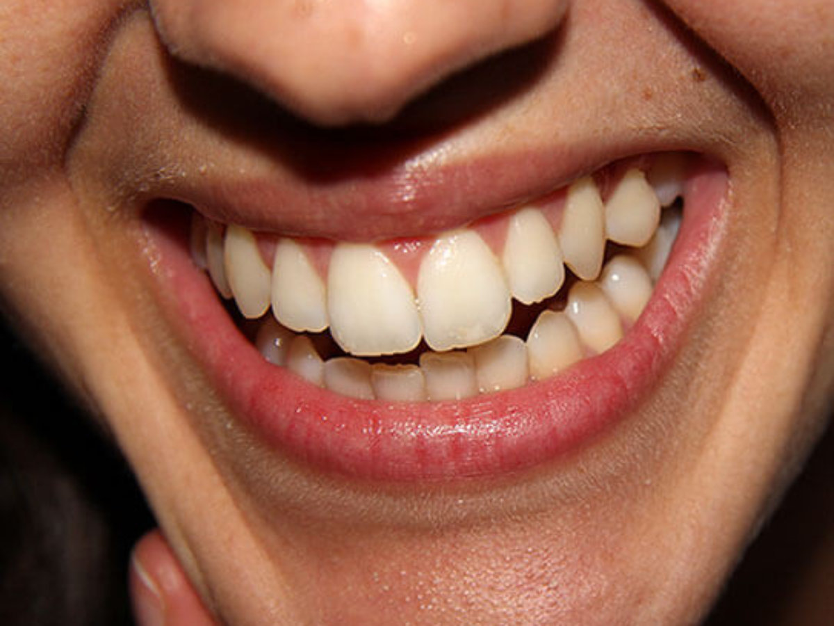 البقع البيضاء على الأسنان: إحدى عشرة نصيحة للتخلص منها