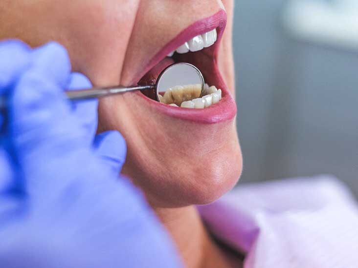 هل يمكن أن تؤدي العدوى في الأسنان إلى الوفاة؟