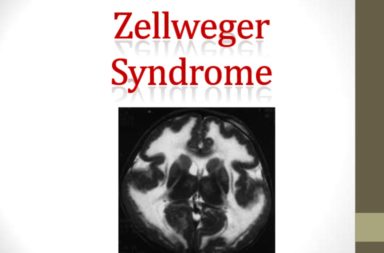 متلازمة زيلويغر: المتلازمة المخية الكبدية الكلوية - اضطراب وراثي يعاني منه الأطفال حديثو الولادة إذ يسبب لهم مشكلات في الدماغ والكبد والكلية